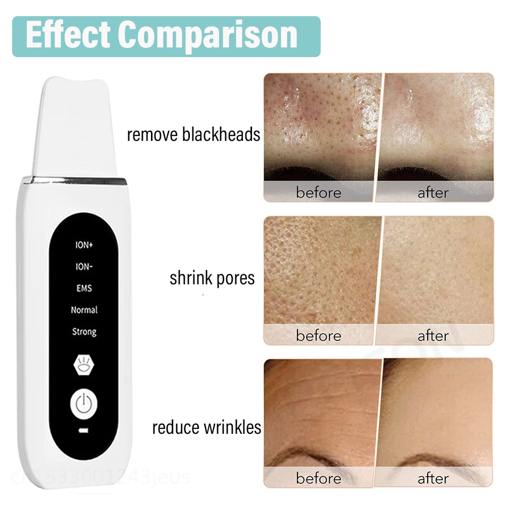 Ultrasonic Skin Scrubber – Professional Pore Cleansing Facial Tool Scrubs Treatments Tidesmit