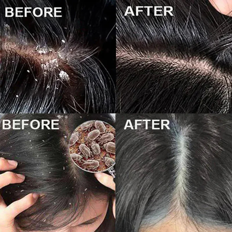 Anti Dandruff Scalp Scrub Treatment for Itch Relief - Tidesmit Scrubs Treatments Tidesmit