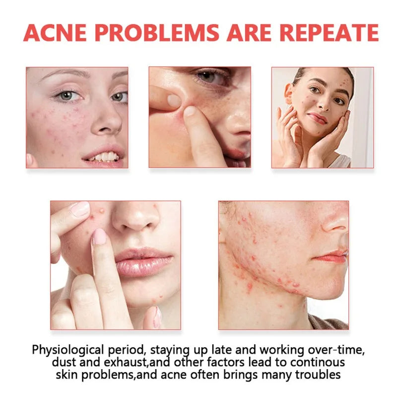 400pcs Star Acne Patches Invisible Pimple Cover for Face Oil Control Spot Treatment Cute Sticker for Covering Zits and Blemishes