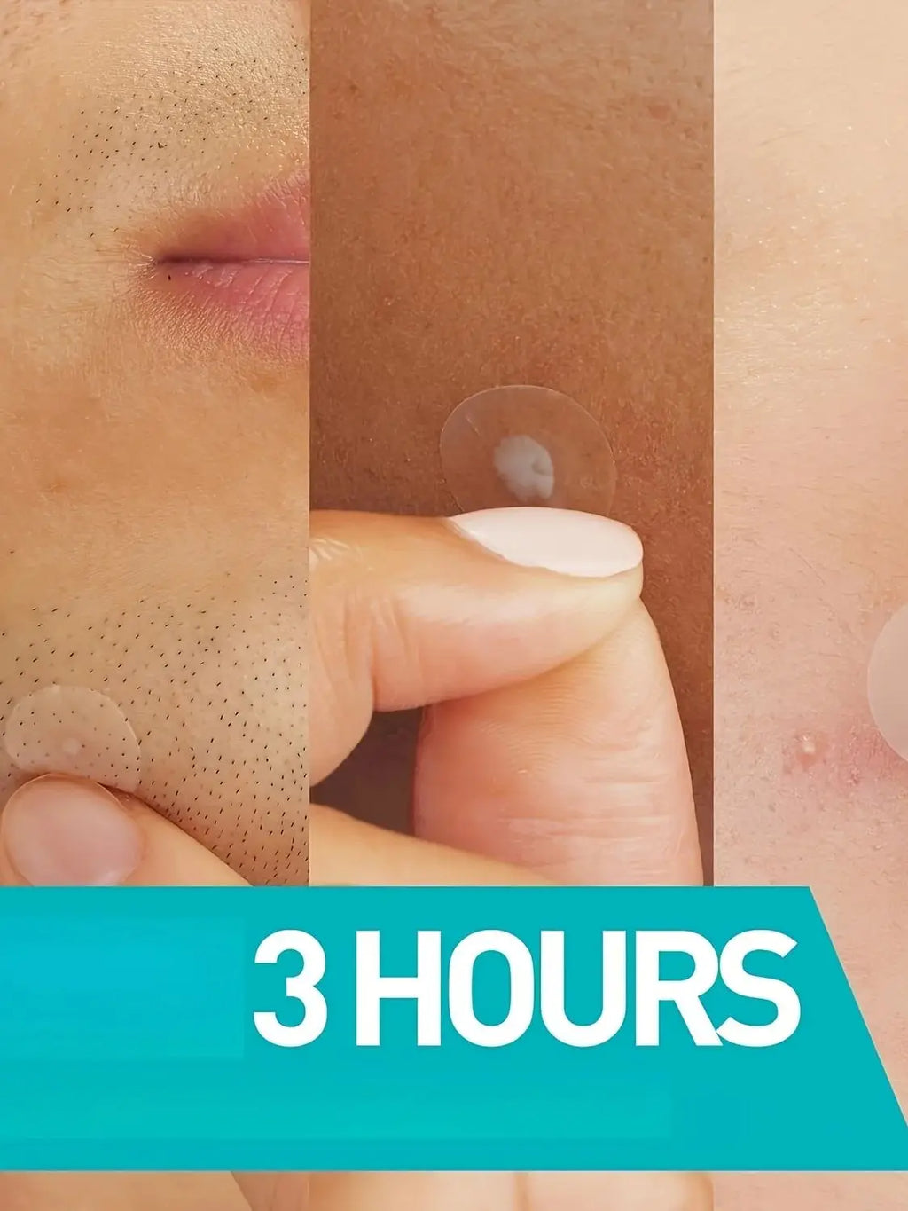 24PCSHydrocolloid acne patches,hydrocolloid invisible patch, mild formula,,which will help with better acne removal