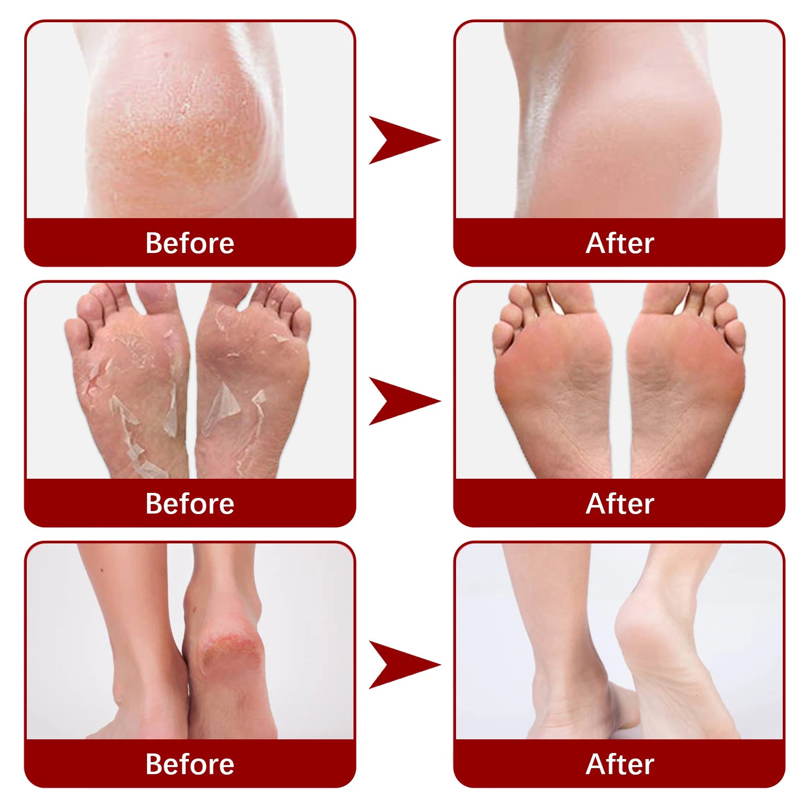 Exfoliating Foot Peel Mask - Apple Extract Callus Remover (5-15 Pack) Scrubs Treatments Tidesmit