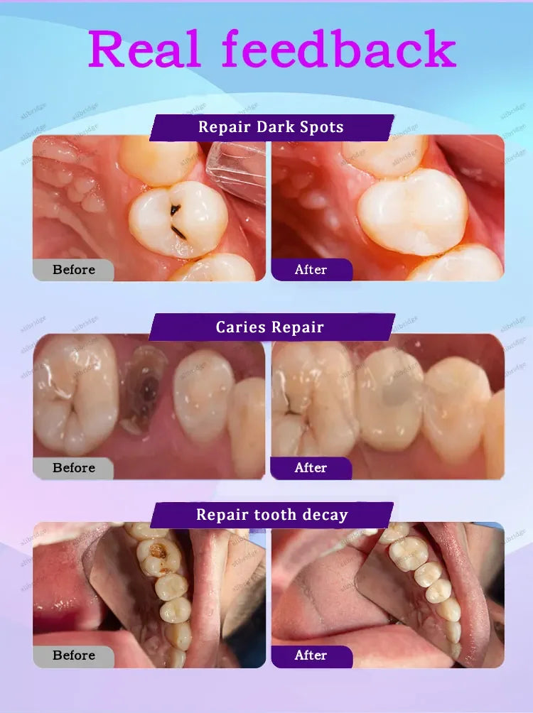 Tidesmit anti-caries teeth whitening treatment for cavity prevention and enamel repair