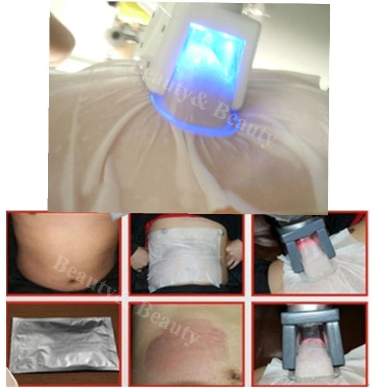 Fat Freezing Membranes for Cryolipolysis - Professional Grade 10 Pack Scrubs Treatments Tidesmit