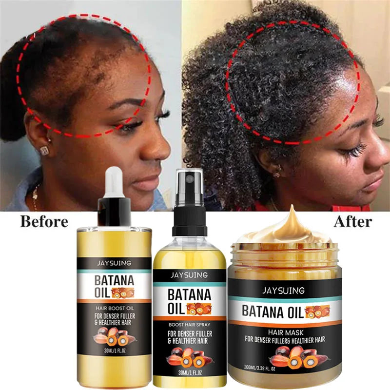 Tidesmit Batana Oil Hair Regrowth Set for Traction Alopecia: Repairing Hair Mask, Growth Spray, and Scalp Treatment.