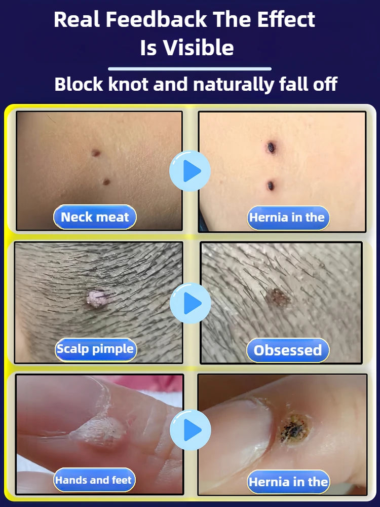 Professional PMU Machine - Precision Skin Tag & Wart Removal Pen Permanent Makeup Machines Tidesmit