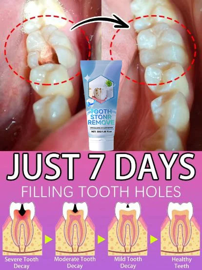 Tidesmit probiotic teeth whitening treatment for repairing tooth decay and deep cleaning teeth