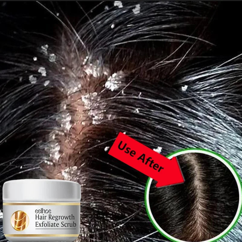 Anti Dandruff Scalp Scrub Treatment for Itch Relief - Tidesmit Scrubs Treatments Tidesmit