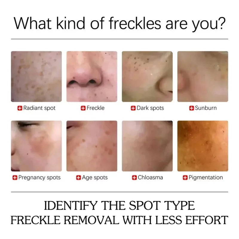 Turmeric Freckle Removing Whitening Essence Fade Pigmentation Melasma Dark Spots Corrector Repair Serum Korean Skin Care
