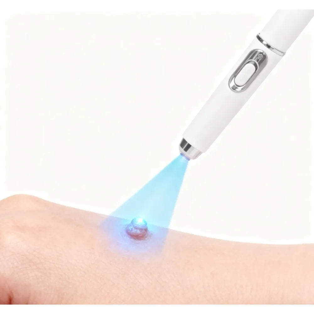 White electric plasma mole removal pen emitting blue laser light on a skin tag for home spot and freckle treatment.